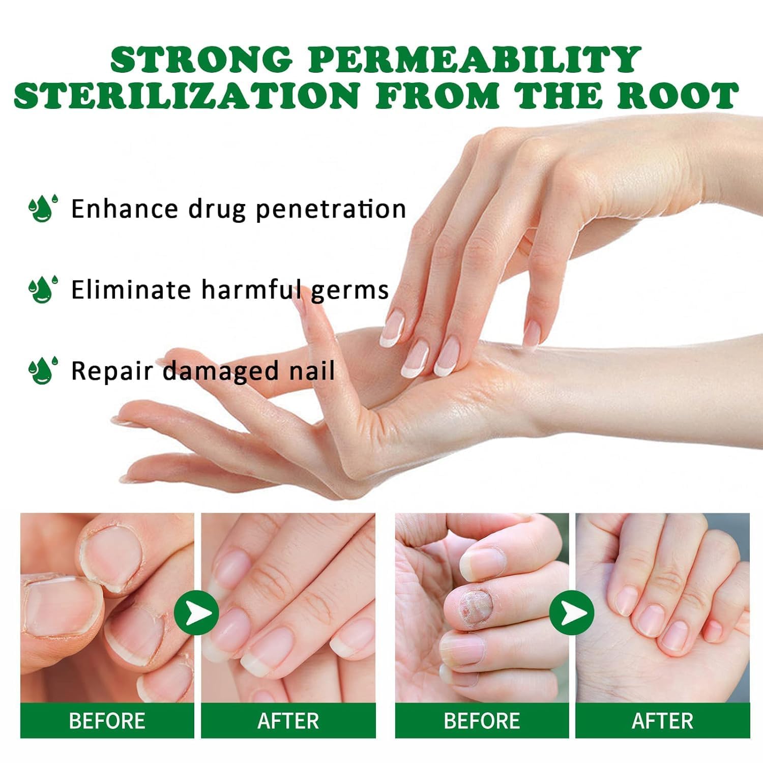 Antifungal Gel - Get rid of nail fungus fast!