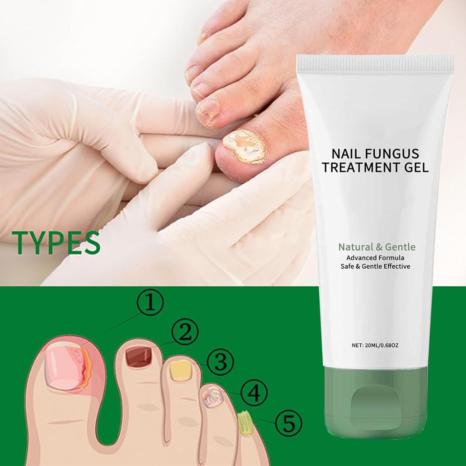 Antifungal Gel - Get rid of nail fungus fast!
