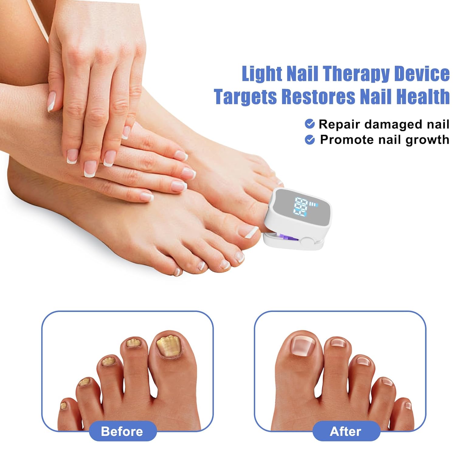 Nail Fungus Treatment Laser for Discolored & Thickened and Paronychia