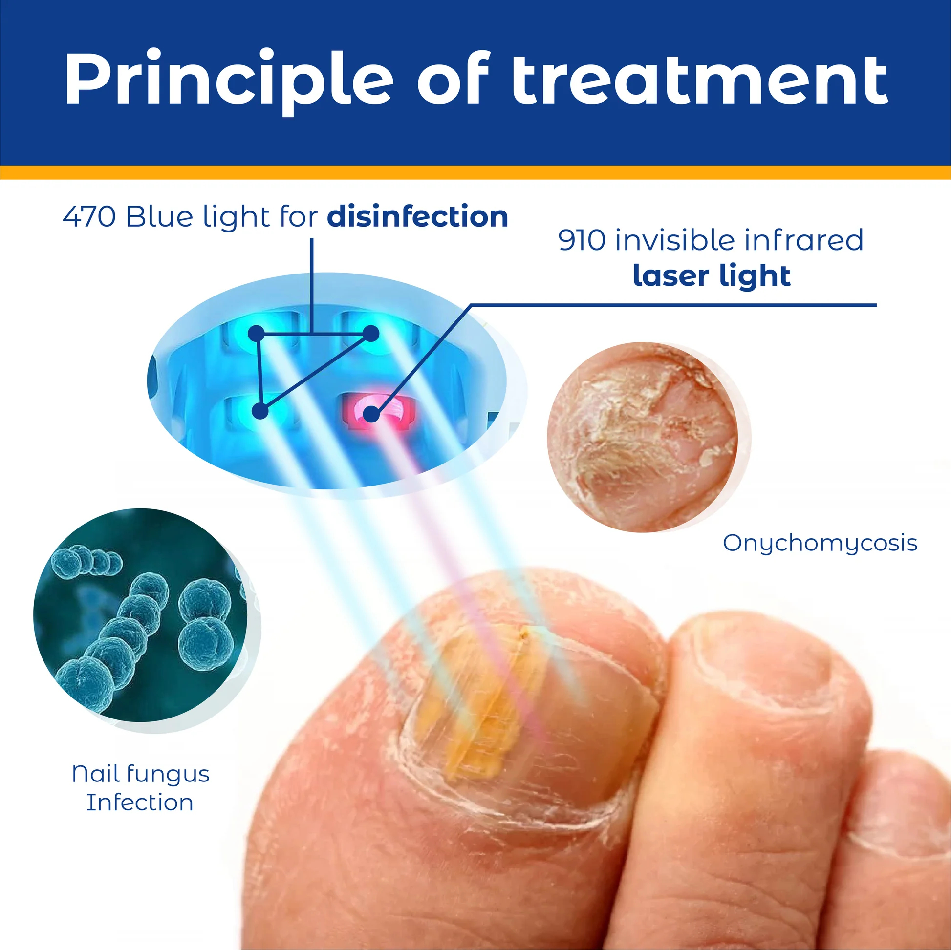 Welnax™ High-Efficiency Light Therapy Device For Toenail Diseases