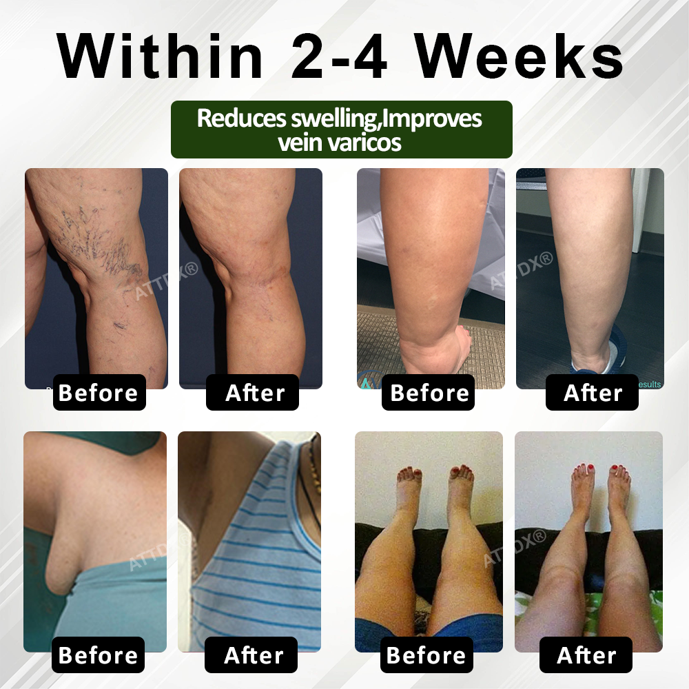 Welnax™ Leg Therapy Edema Cream