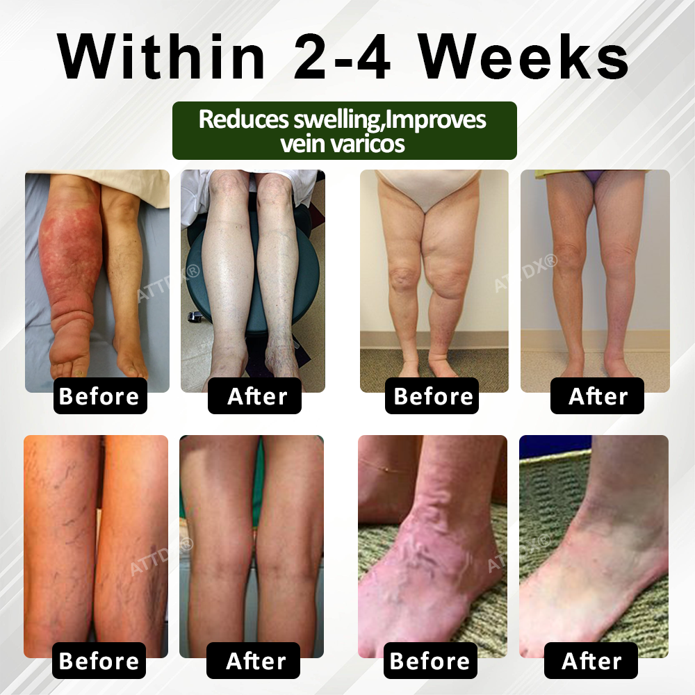 Welnax™ Leg Therapy Edema Cream