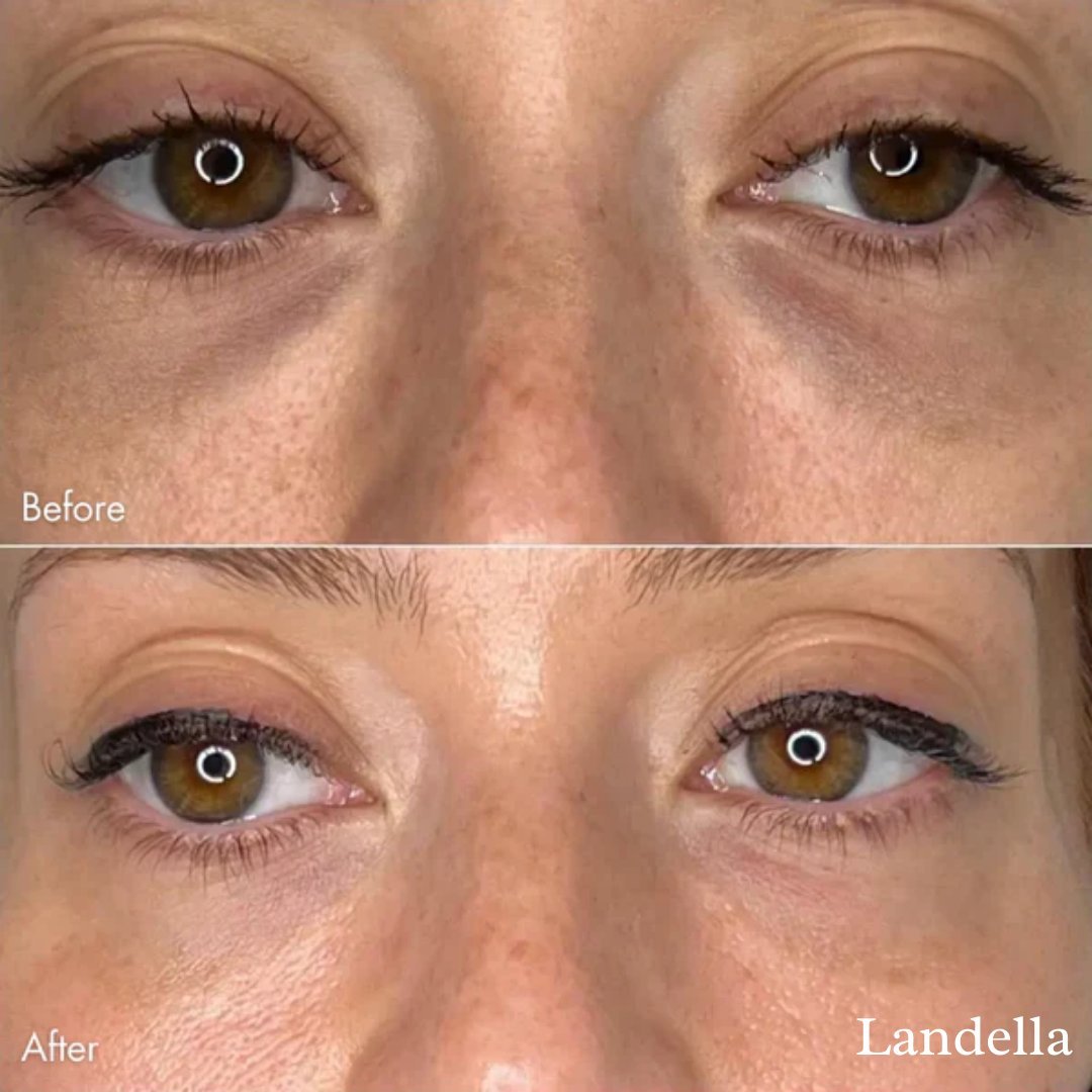✨Limited Sale 49% OFF✨ Landella MicroGlow Patches
