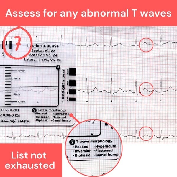 🔥ECG/EKG Rhythm Pocket Card