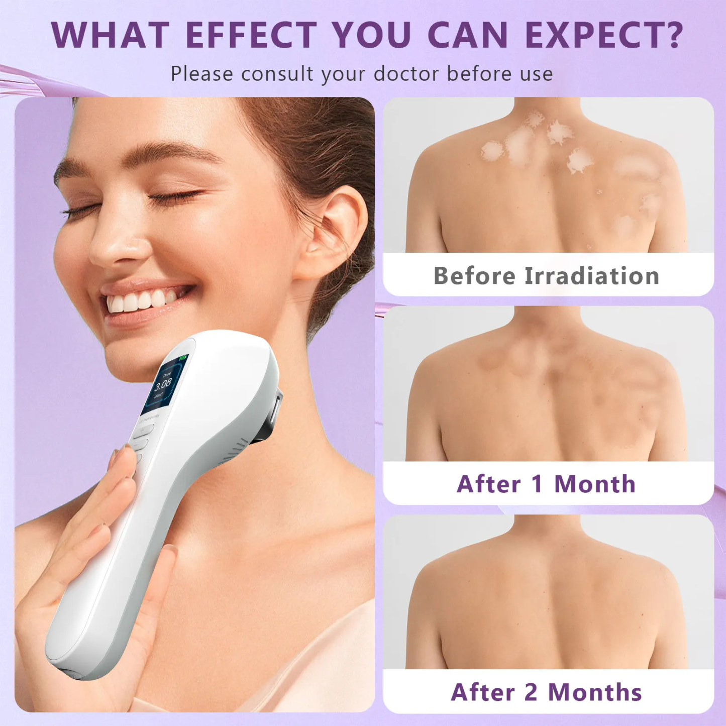 Handheld UVB Light Therapy Device for Vitiligo, Psoriasis & Eczema