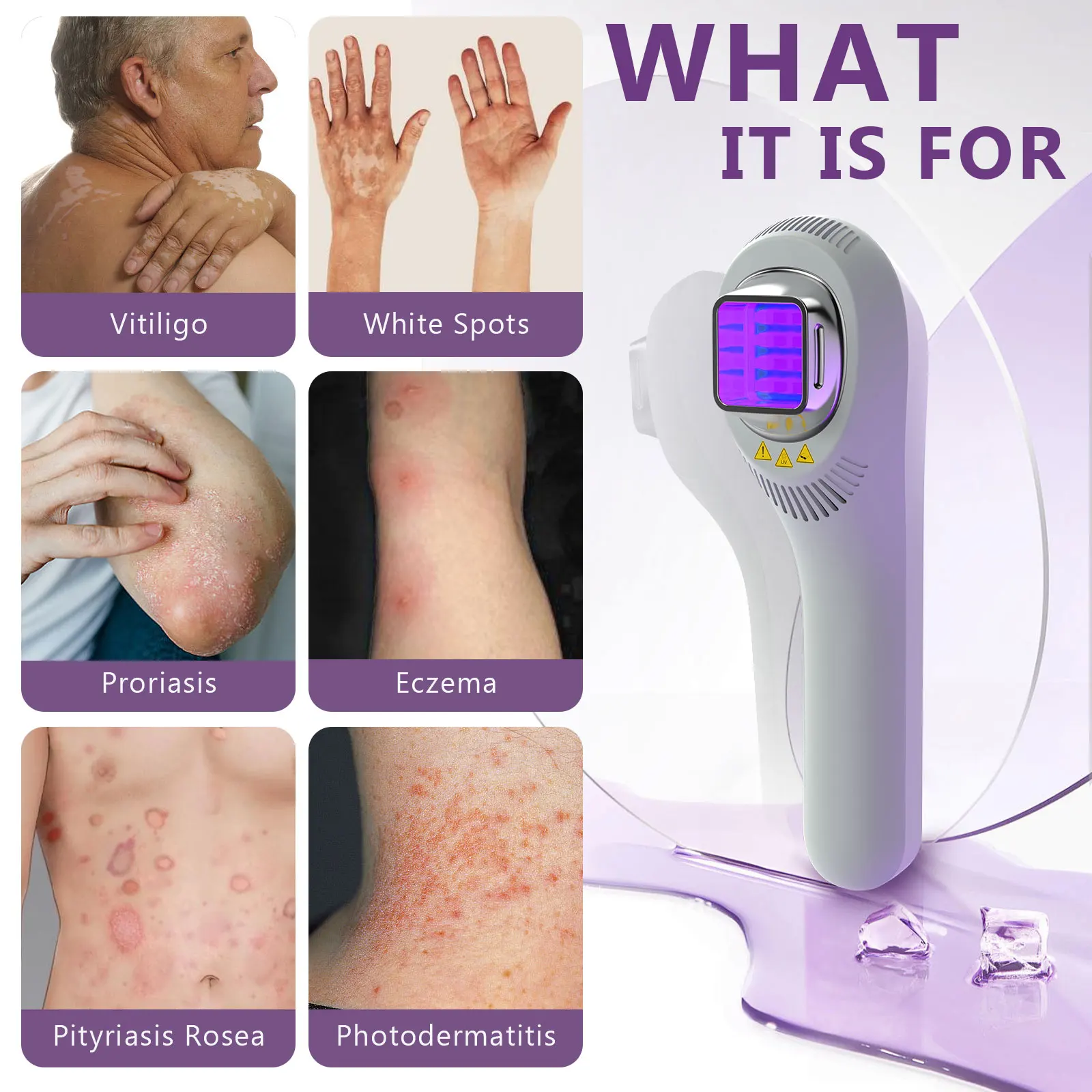Handheld UVB Light Therapy Device for Vitiligo, Psoriasis & Eczema