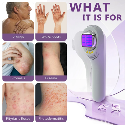 Handheld UVB Light Therapy Device for Vitiligo, Psoriasis & Eczema