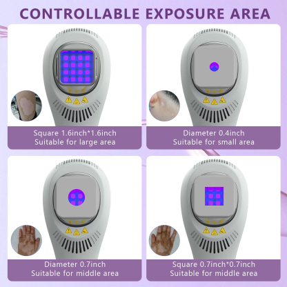 Handheld UVB Light Therapy Device for Vitiligo, Psoriasis & Eczema