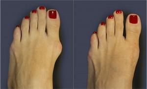 Op&eacute;ration d'oignon.  Chirurgie de l'oignon ou de l'hallux valgus - Clinique Podologique de M&aacute;laga Centro
