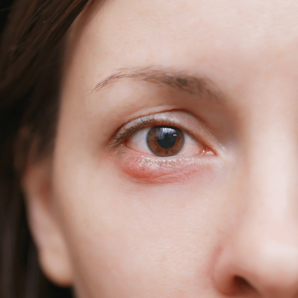 Can I Wear Contacts with a Stye? Unibling's Experts Weigh In