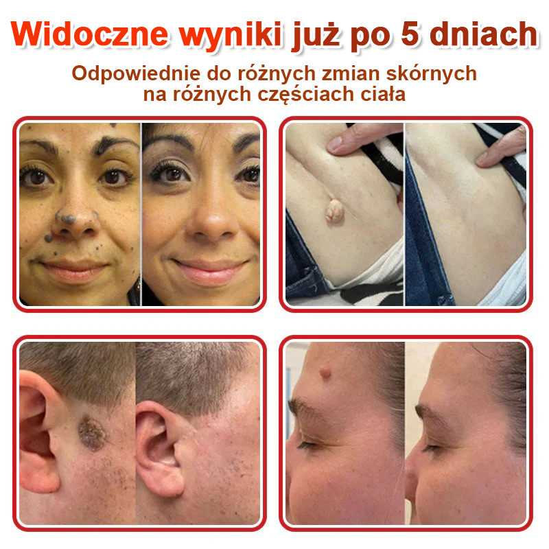🌈 KUBOZN® Mikroigłowy Botaniczny Plaster na Usuwanie Brodawek Skórnych