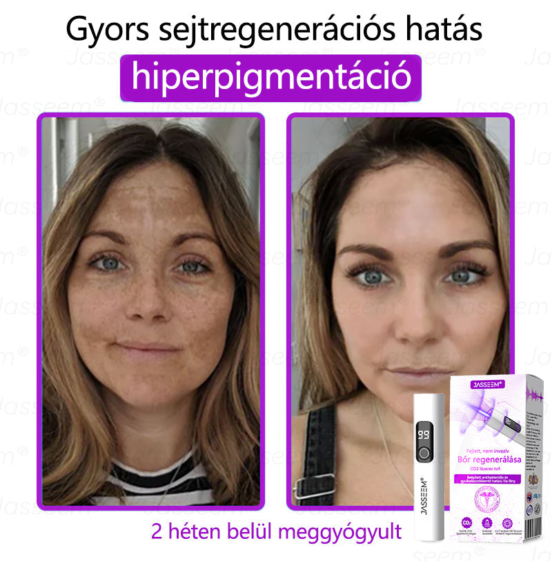 𝐉𝐚𝐬𝐬𝐞𝐞𝐦® Fejlett, nem invazív bőrjavító CO₂ lézeres toll 🎉 (Gyengéden eltávolítja a szemölcsöket, anyajegyeket, öregségi foltokat és bőrkinövéseket – fájdalom és gond nélkül!)