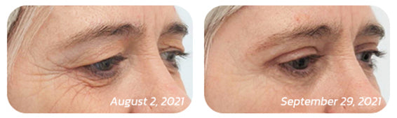 Youthful eye transformation