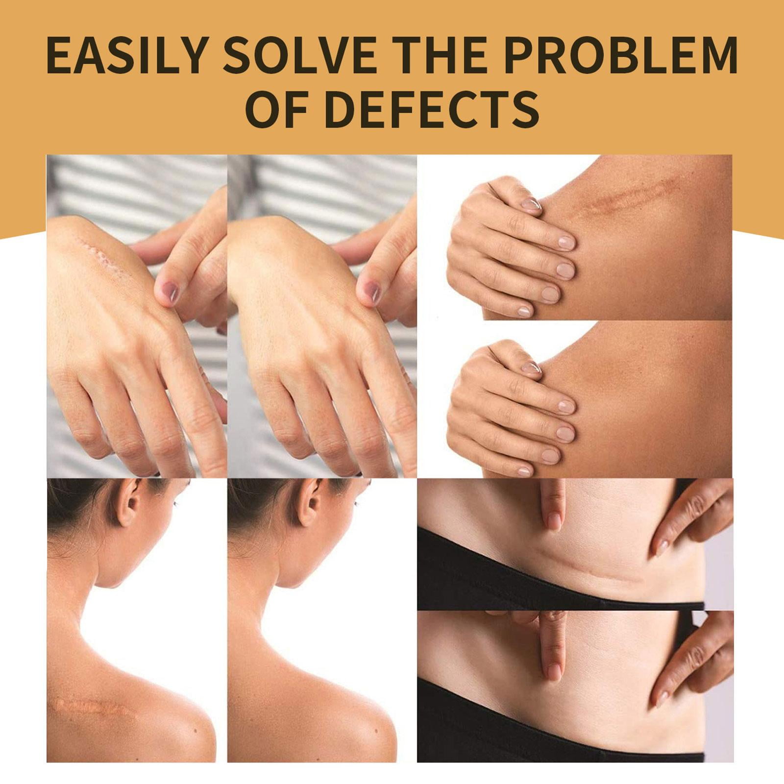 Invisible scar repair concealer patch（Can be cut at will）