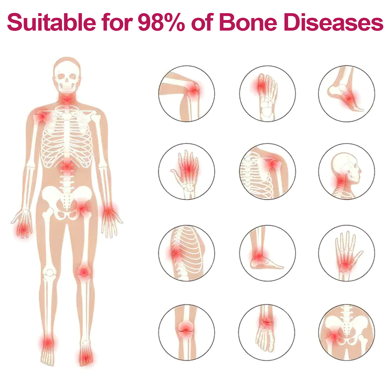 Bee poison Pain ArthritisTherapy Cream (specially forolder adults & AAOSrecommends)