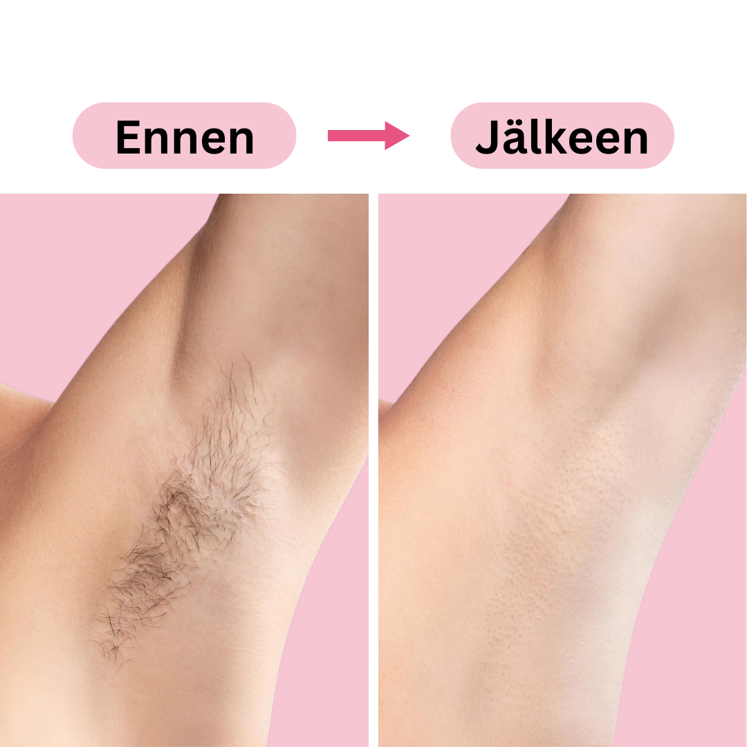 IPL Light Epilator – Hair Removal Device