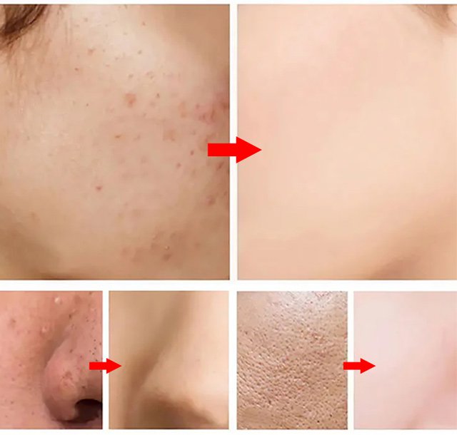 Electric Blackhead Remover Beauty Instrument