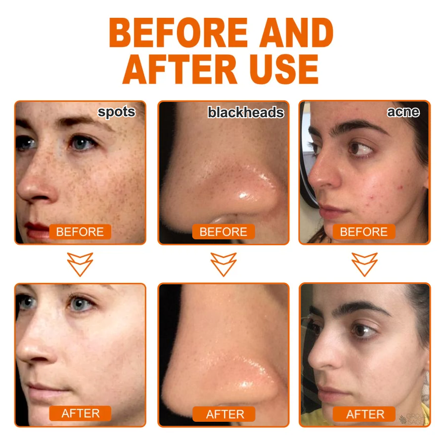 🔥[Official Brand Store]  Herbal Spots Peel-Off Facial Mask