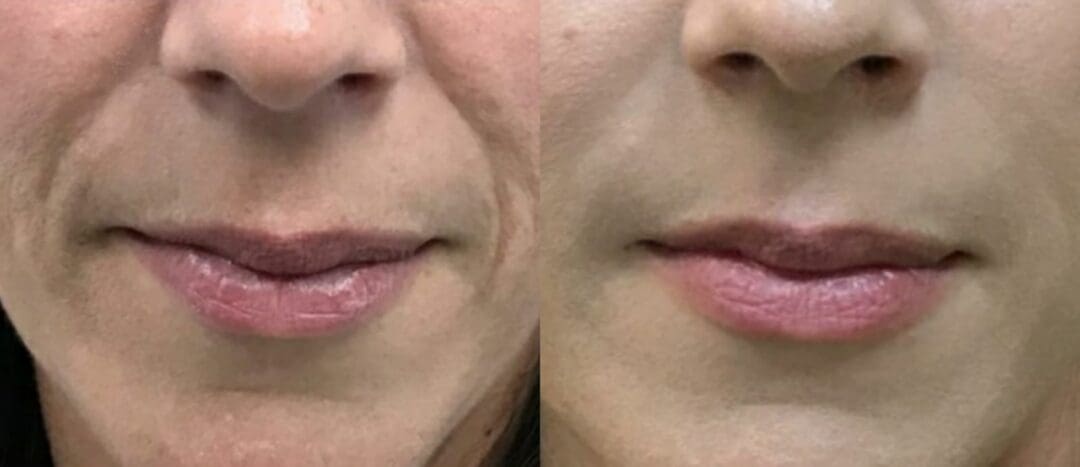 Chinese Mustache Filler Before and After - Fit Body Aesthetics Clinic