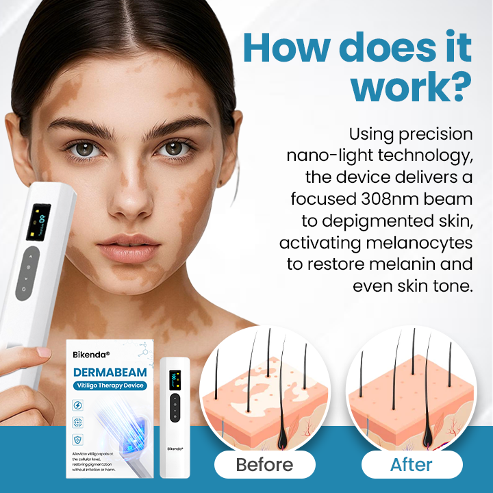 DermaBeam Vitiligo Therapy Device