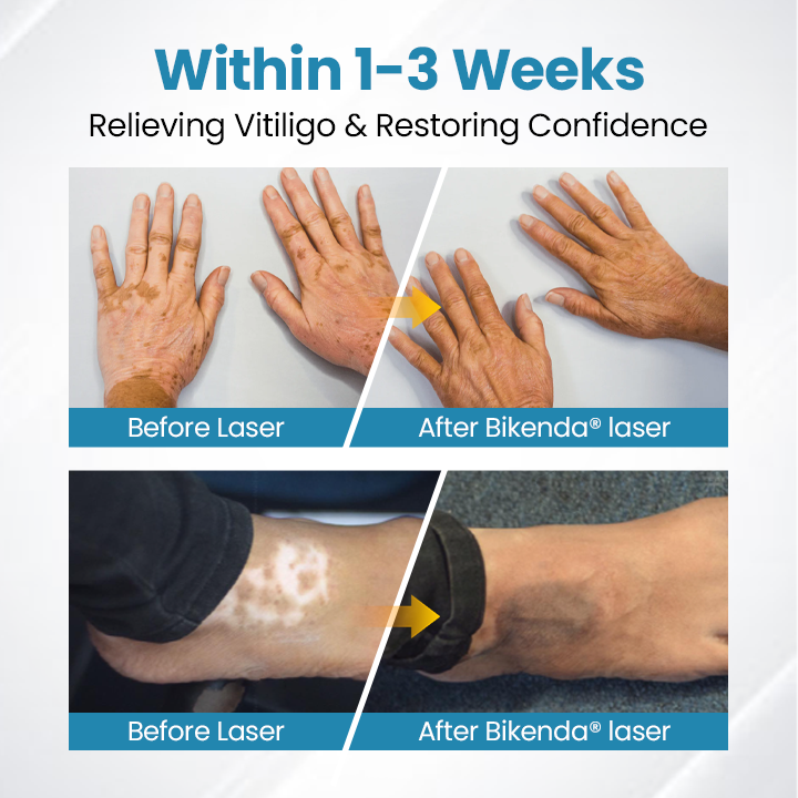 DermaBeam Vitiligo Therapy Device
