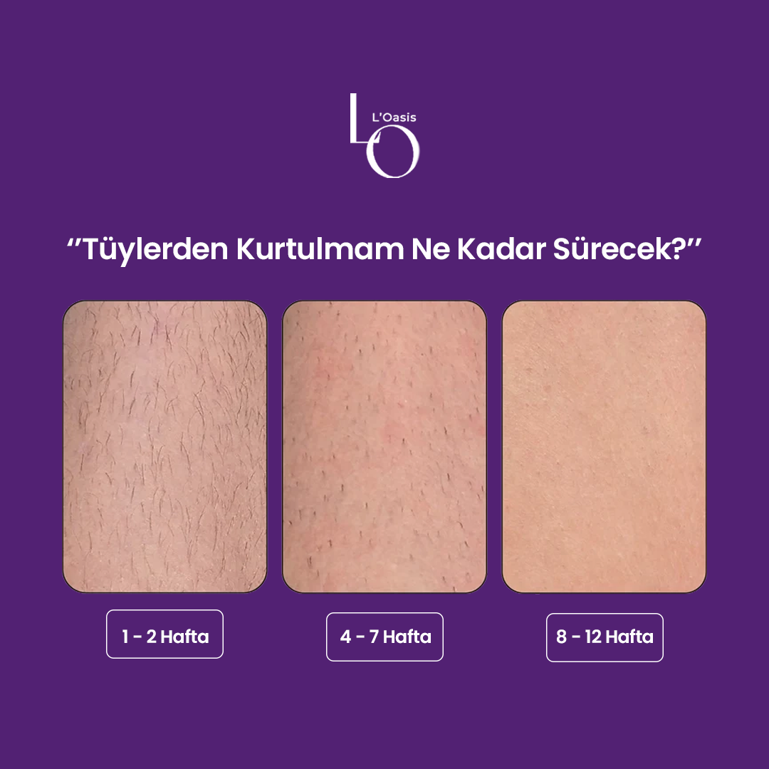 L'Oasis IPL Epilasyon - Evde Profesyonel Lazer Alternatifi