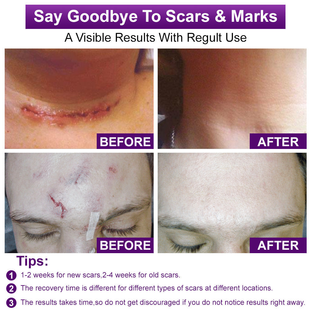 Scar Gel – Clinically Proven Formula to Soften, Flatten & Fade Scars from Surgery, Acne, Burns, and Keloids