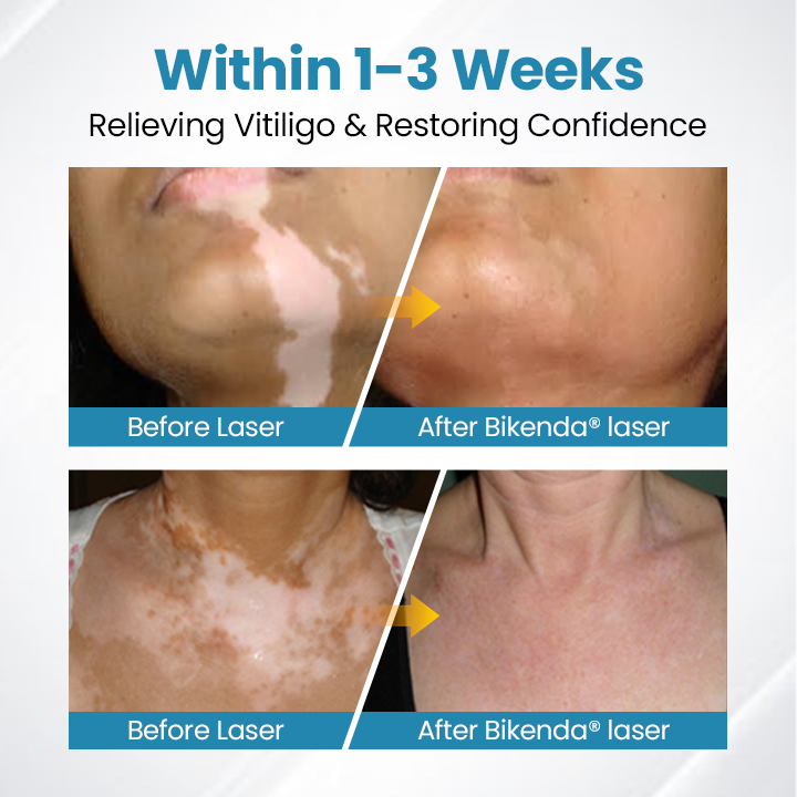 DermaBeam Vitiligo Therapy Device