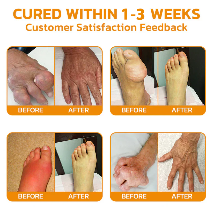 Bee poison Pain ArthritisTherapy Cream (specially forolder adults & AAOSrecommends)