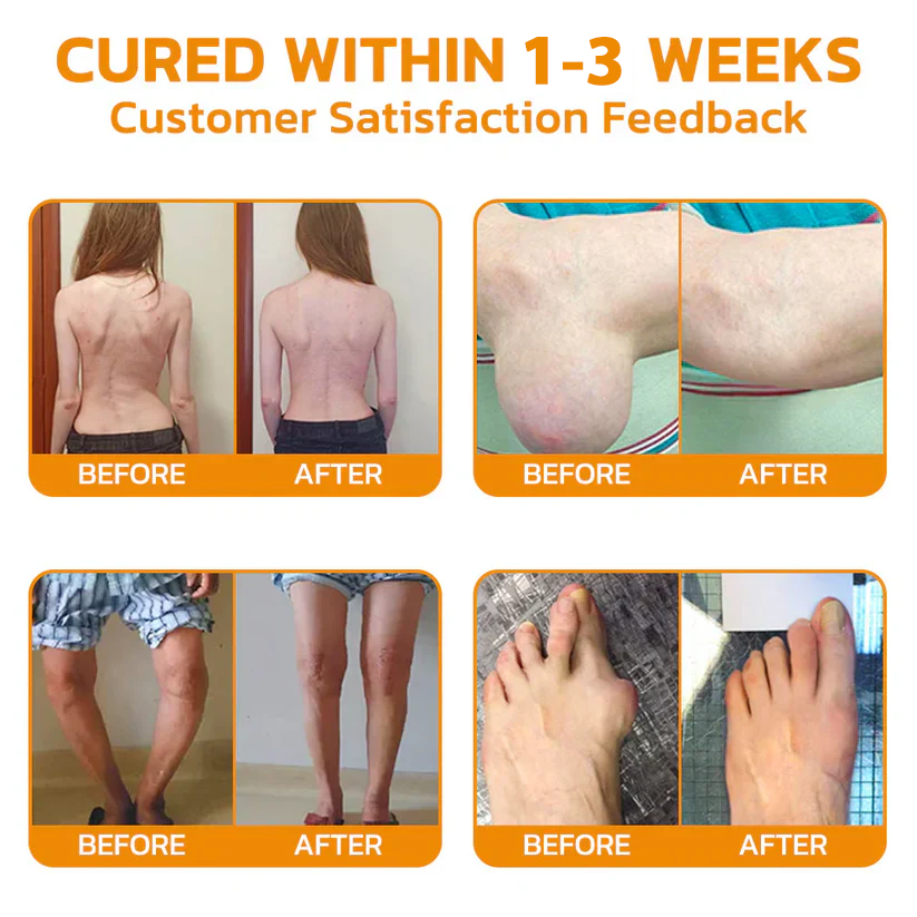 Bee poison Pain ArthritisTherapy Cream (specially forolder adults & AAOSrecommends)