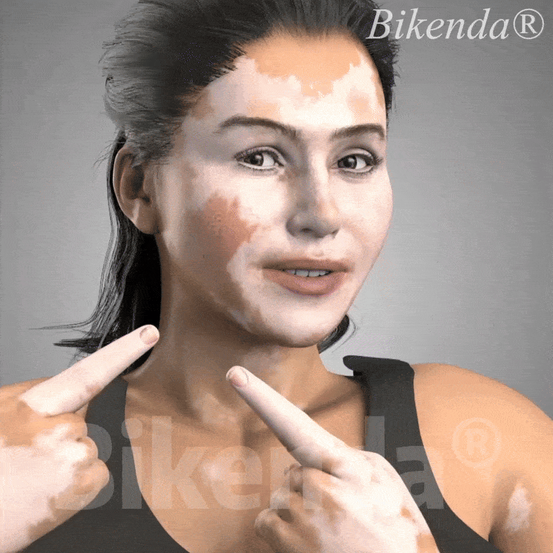 DermaBeam Vitiligo Therapy Device