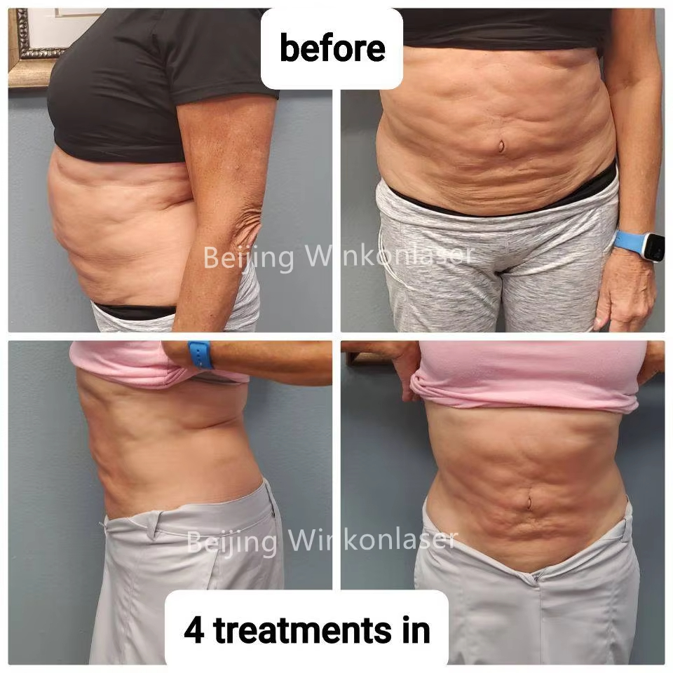 6D Laser 532Nm Wavelength Lipolysis Fat Burning Body Slim Lipo Laser Machine