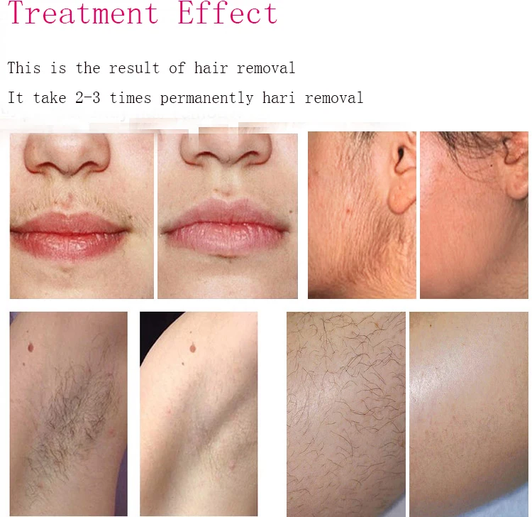 4 Wavelength 755/808/940/1064nm Diode Laser Hair Removal/500w-1600w Diode Laser Beauty Machine/Skin Rejuvenation 1200w 1000w