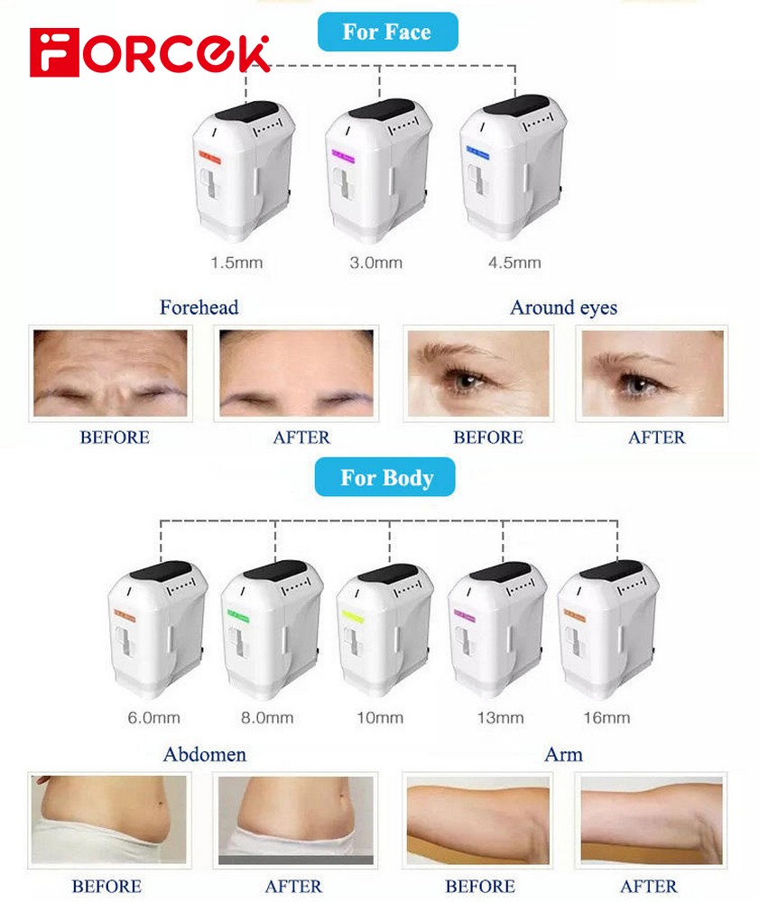 2 In 1 4D HIFU+Vmax Radar Fine Carving Handle Machine For Wrinkle Removal Skin Lift Tightening
