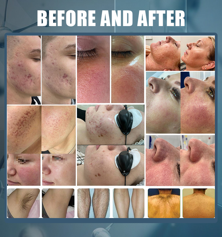 2021 hottest ipl hair removal skin rejuvenation acne treatment wrinkle removal spa machine