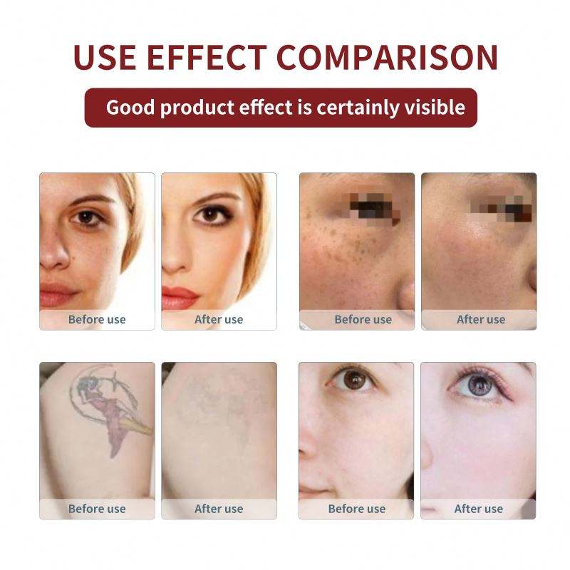 Professional 532nm 1064nm 1320nm Lazer Tattoo Removal Carbon Peeling Picosecond Tattoo Removal Machine