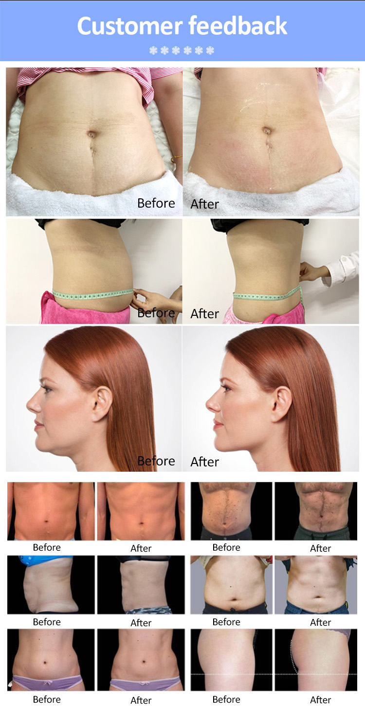 Cryolipolysis Machine Cryo Fatty Freezing Cold Vacuum Fat Freezing Machine Double Chin Removal 360 Cryolipolysis Machine