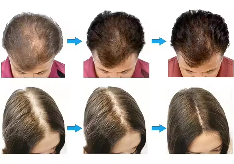5in1 Scalp Massage Hair Loss Treatment Growth Hair Analysis Device Hair Analyzer Machine with Comparison Mode