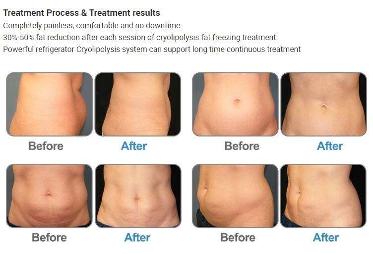 Cryo Slimming MachineDouble Chin Cryo Slim 360 Cryolipolysis Slimming Cyrolipolysis Cool Fat Freezing Sculpting Machine