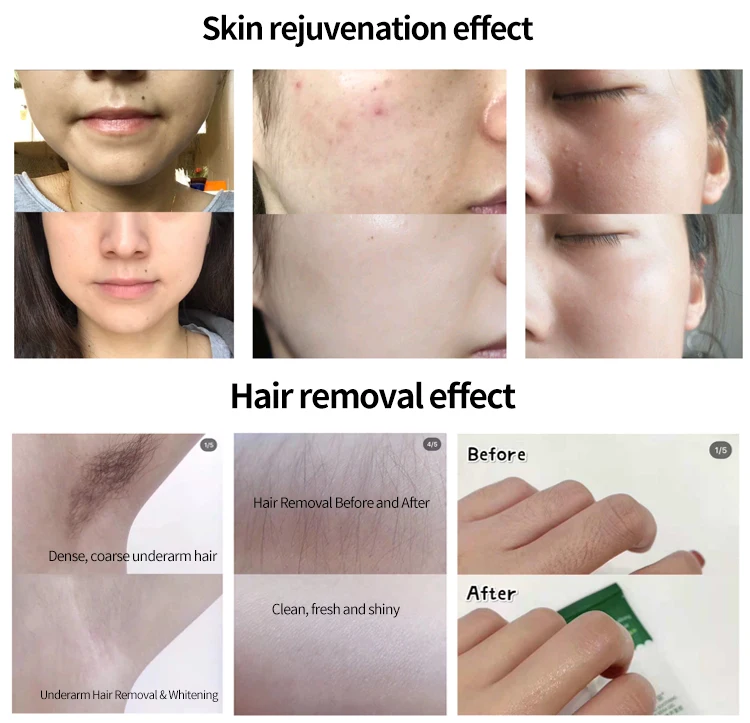 Functional Skin Care Skin Rejuvenation Machine Redness Removal DPL 550-650nm Spot Removal Fast Hair Removal Machine