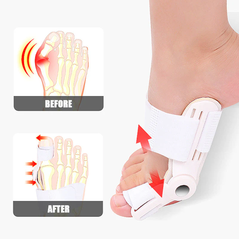 3D Bunion Splint Corrector Toe Trainer