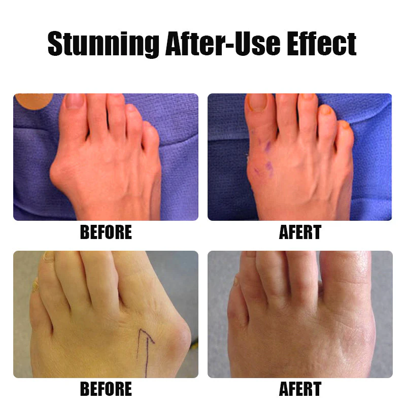 3D Bunion Splint Corrector Toe Trainer