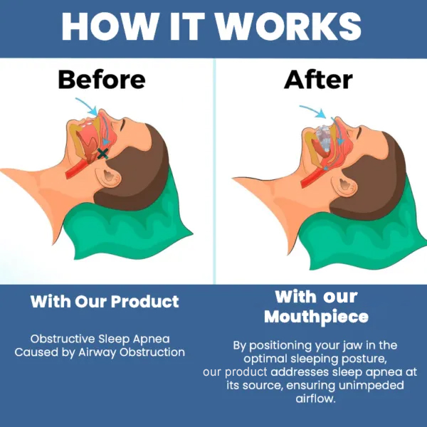 Anti Snore Mouthpiece