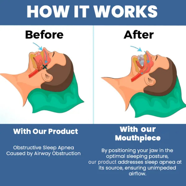 Anti Snore Mouthpiece