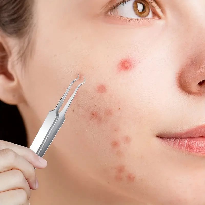 🔥Professional Facial Blackhead Remover Tweezers