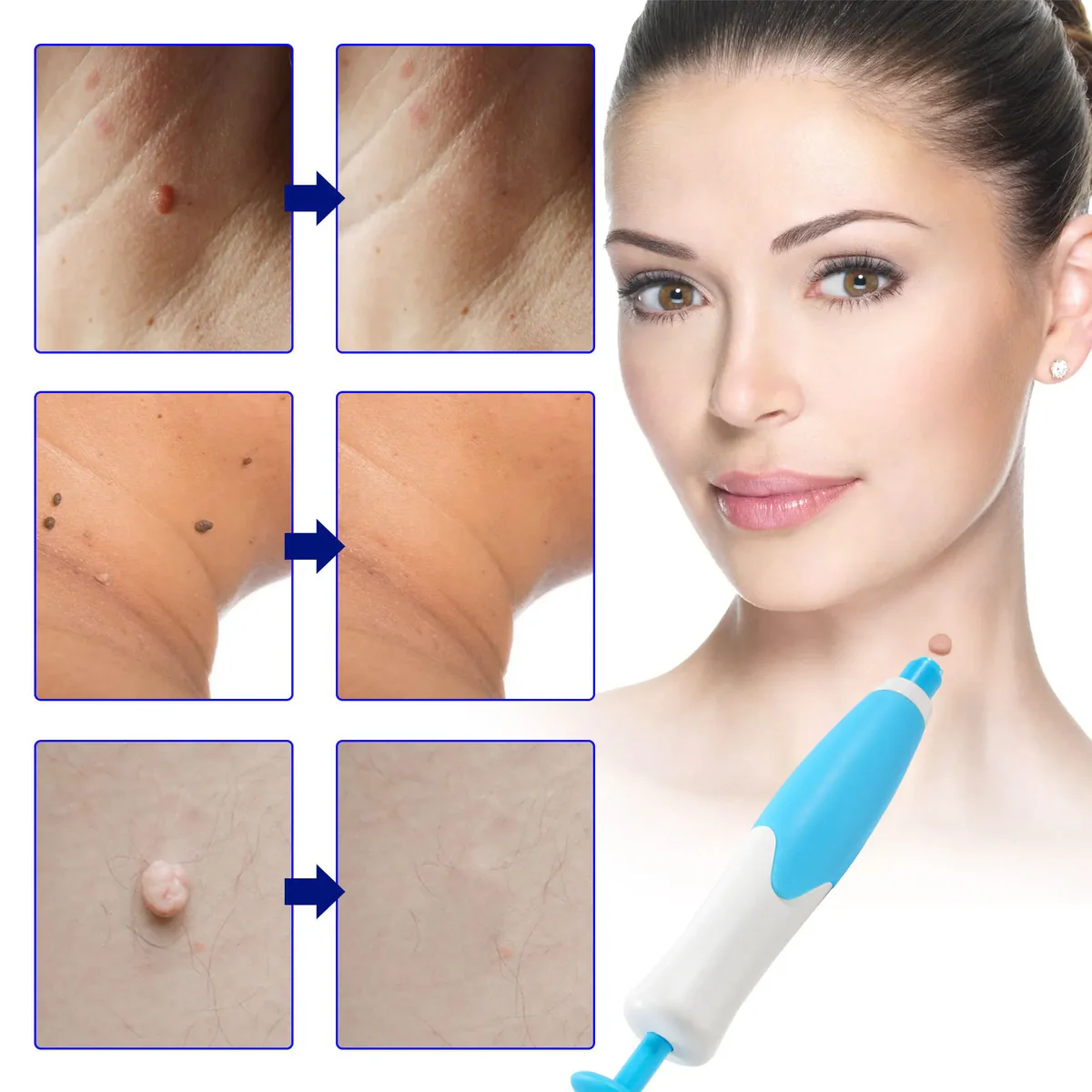 Auto Skin Tag Removal Professional Kit