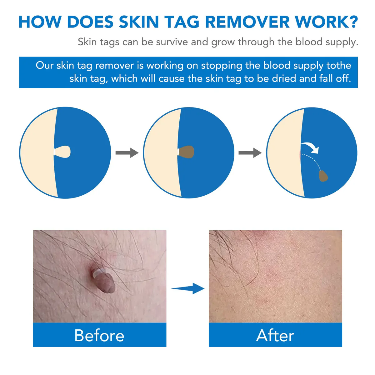 Auto Skin Tag Removal Professional Kit