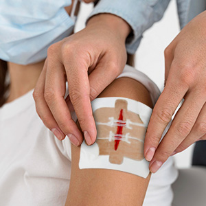 butterfly bandages for wound closure