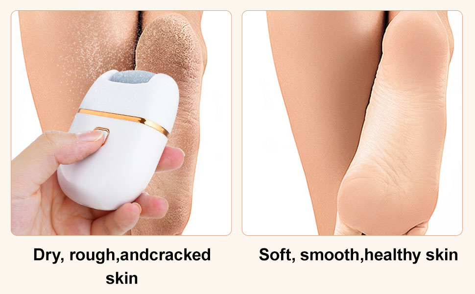 electric callus remover for feet