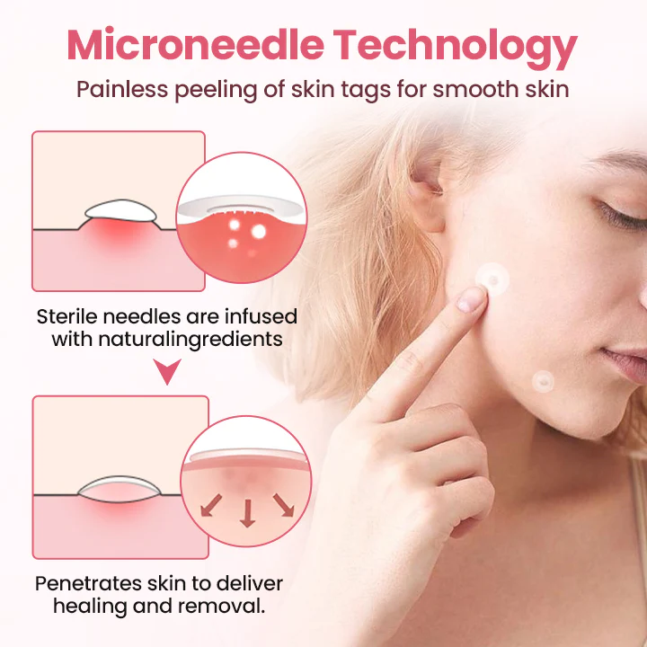 Plasture nedureros Biancat® pentru îndepărtarea negilor micro